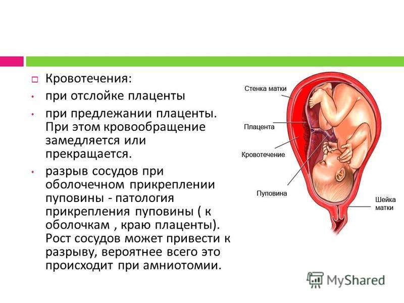 Презентация отслойка плаценты