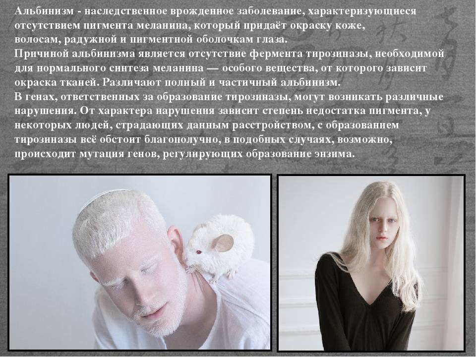 Какое бывает зрение у альбиносов. «белая ворона», или особенности здоровья и развития ребенка-альбиноса. лечение и прогноз альбинизма