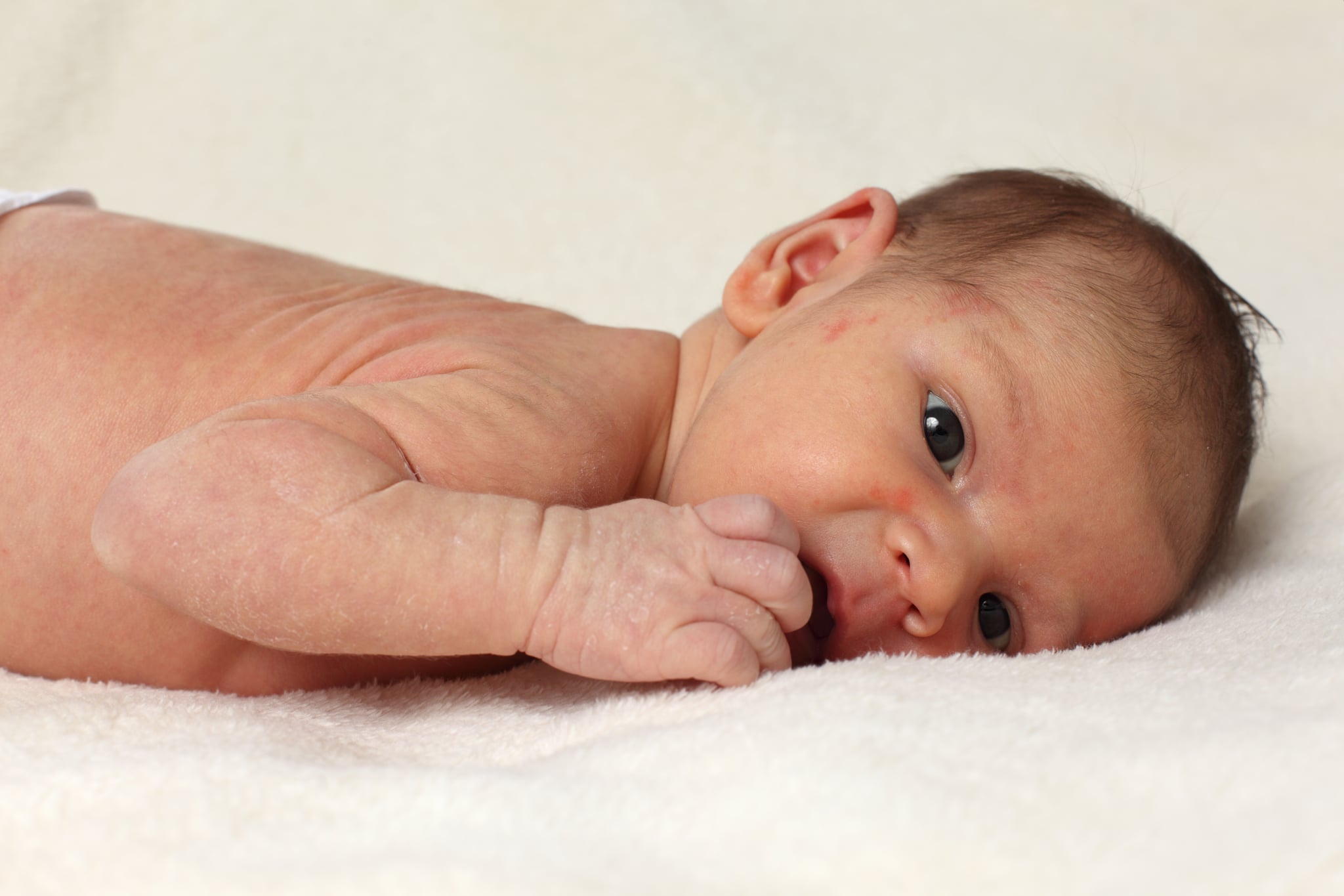 Злокачественная пузырчатка новорожденных