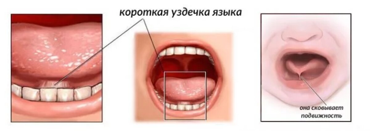 Пластика уздечки губы и языка, причины и лечение в детской стоматологии