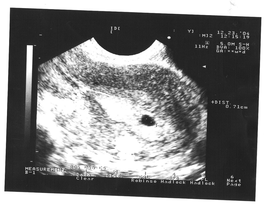 5 неделя беременности: ощущения, развитие плода, фото узи. что происходит с организмом?