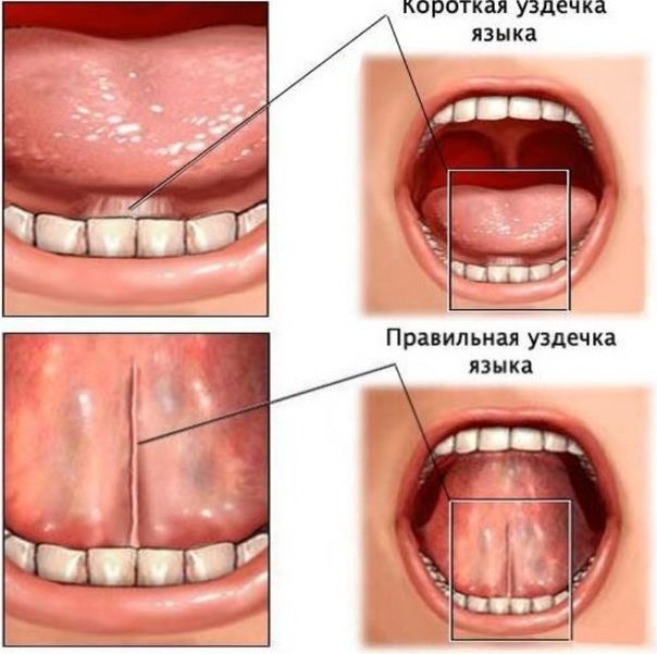Короткая уздечка языка или верхней губы у ребенка: в каком возрасте подрезать и надо ли это делать?