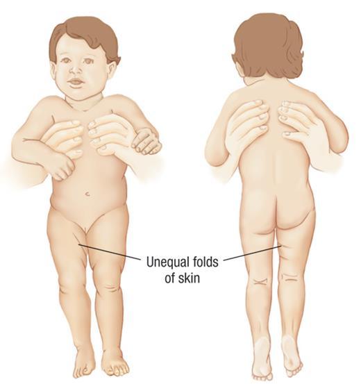 Несимметричные складки на ножках у грудничка, причины асимметрии у младенцев