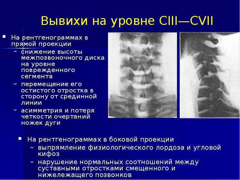 Подвывихи у ребенка - причины формирования, основные симптомы и принципы лечения