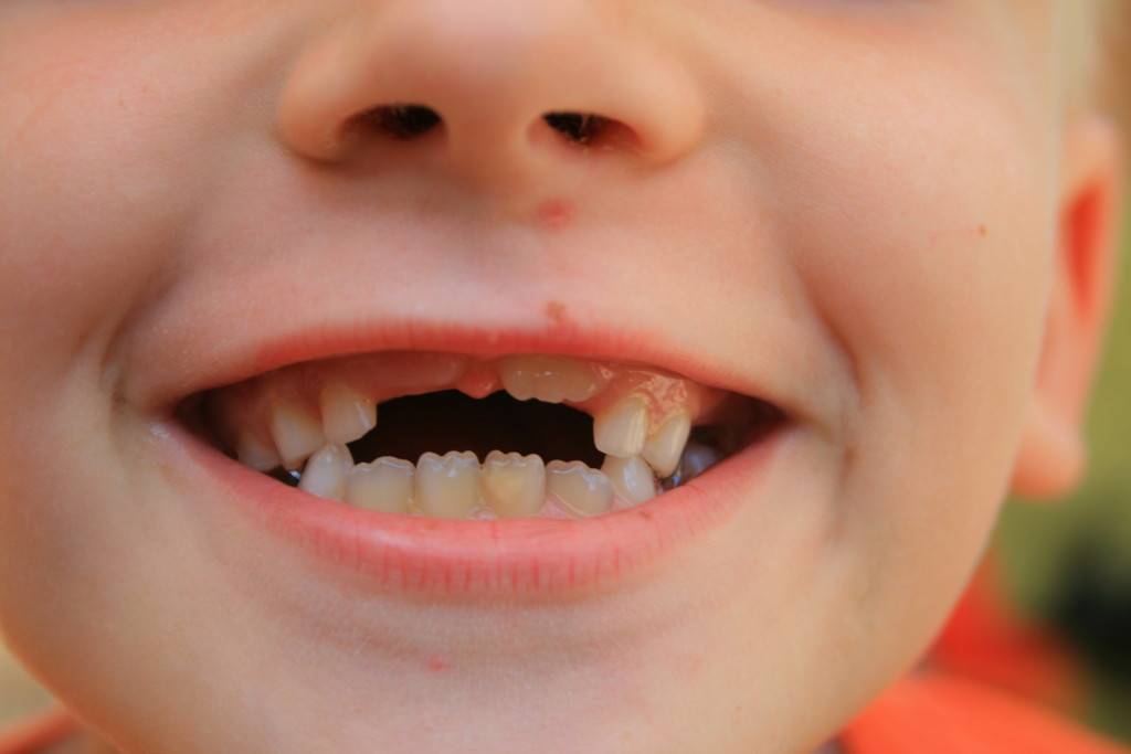 Кариес у детей - нужно ли удалять зуб?