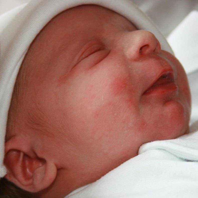 Токсическая эритема новорожденных: стоит ли ее бояться