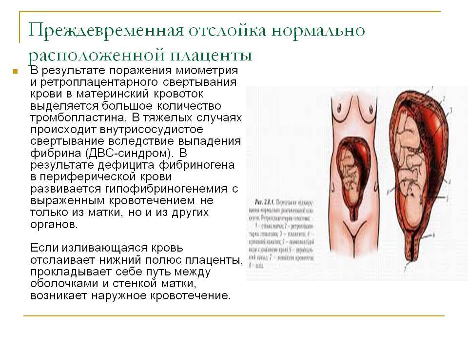 Преждевременная отслойка плаценты презентация