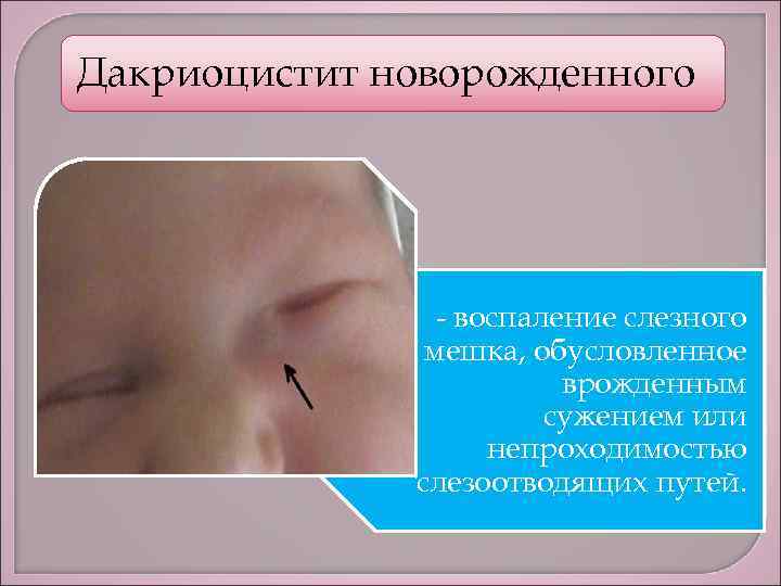 Дакриоцистит у новорожденных: 3 ведущих причины, 7 возможных осложнений, 5 методов диагностики, лечение заболевания