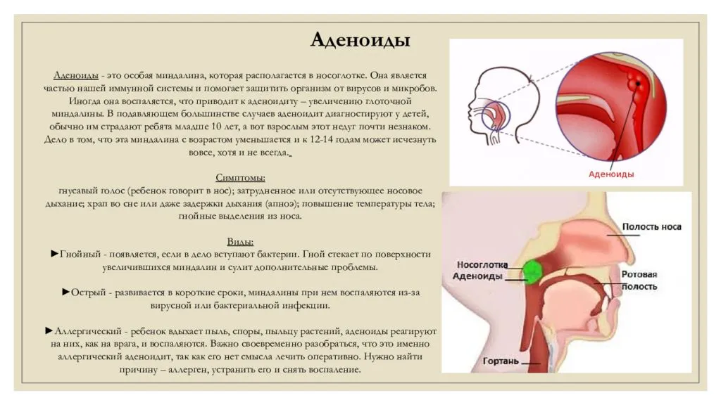 Острый и хронический синусит (гайморит, фронтит, этмоидит)