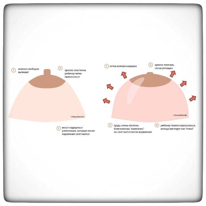 Как перетянуть грудное молоко (перевязать грудь) для предотвращения лактации: фото