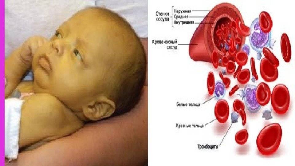Анемия у грудного ребенка