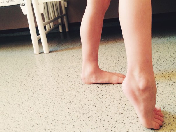 Почему ребенок ходит на цыпочках в 2-3 года (на носочках): комаровский