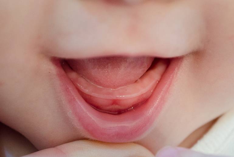 Коренные зубы у детей: схема роста, возможные осложнения - underson clinic