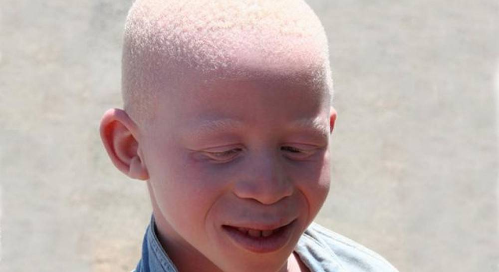 Глазной альбинизм - что это, описание, фото