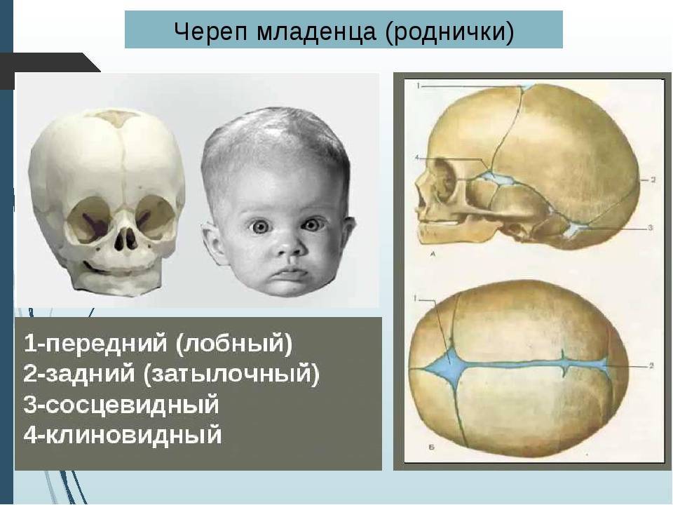 Преждевременное закрытие черепных швов у детей