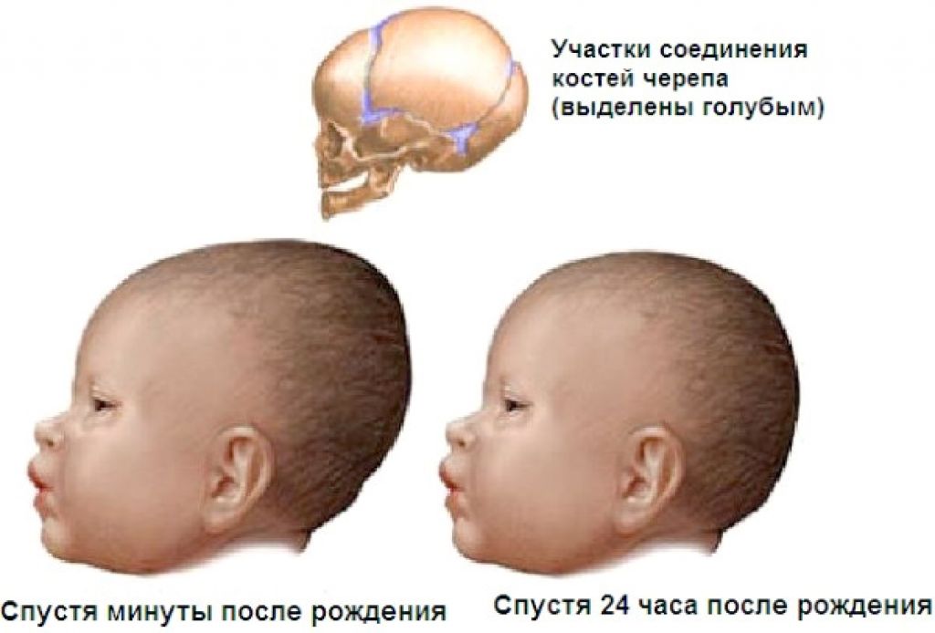 Сколько голова новорожденного. Форма головы новорожденного. Формы черепа у новорожденных. Форма головки новорожденного.