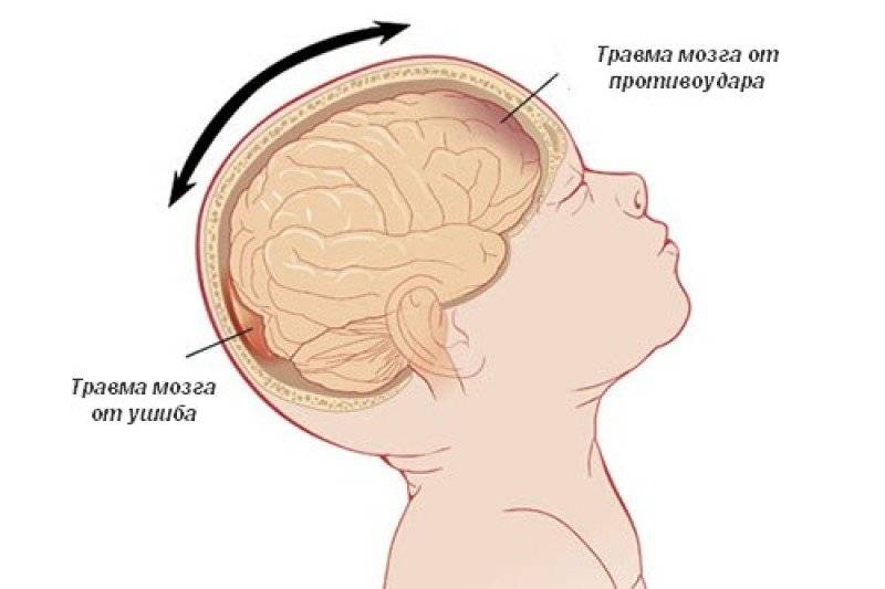 Ушиб головного мозга - каковы последствия травм