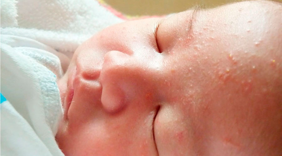 Сыпь на лице у ребенка 1-5 месяцев: причины – эл клиника
