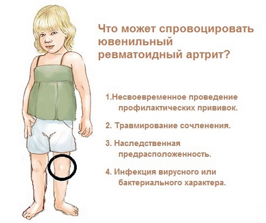 Реактивный артрит лечение в киеве - симптомы синдрома рейтера