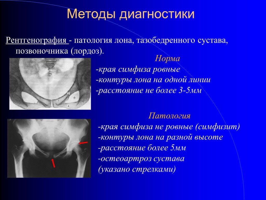 Симфизит. расхождение тазовых костей во время беременности