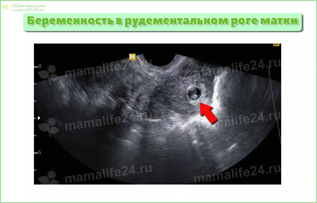 Внематочная беременность: лапароскопические гинекологические операции, выполняемые врачами медцентра мцк-3 (серпухов)