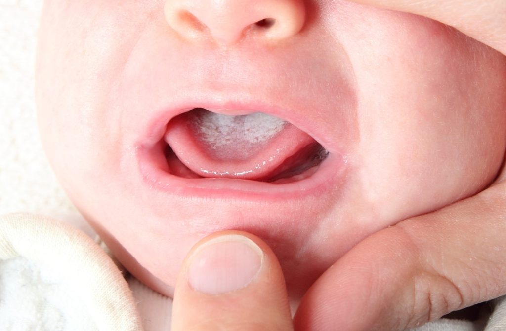 Возможные причины белого налёта на языке и 3 способа его очистки у грудных детей
