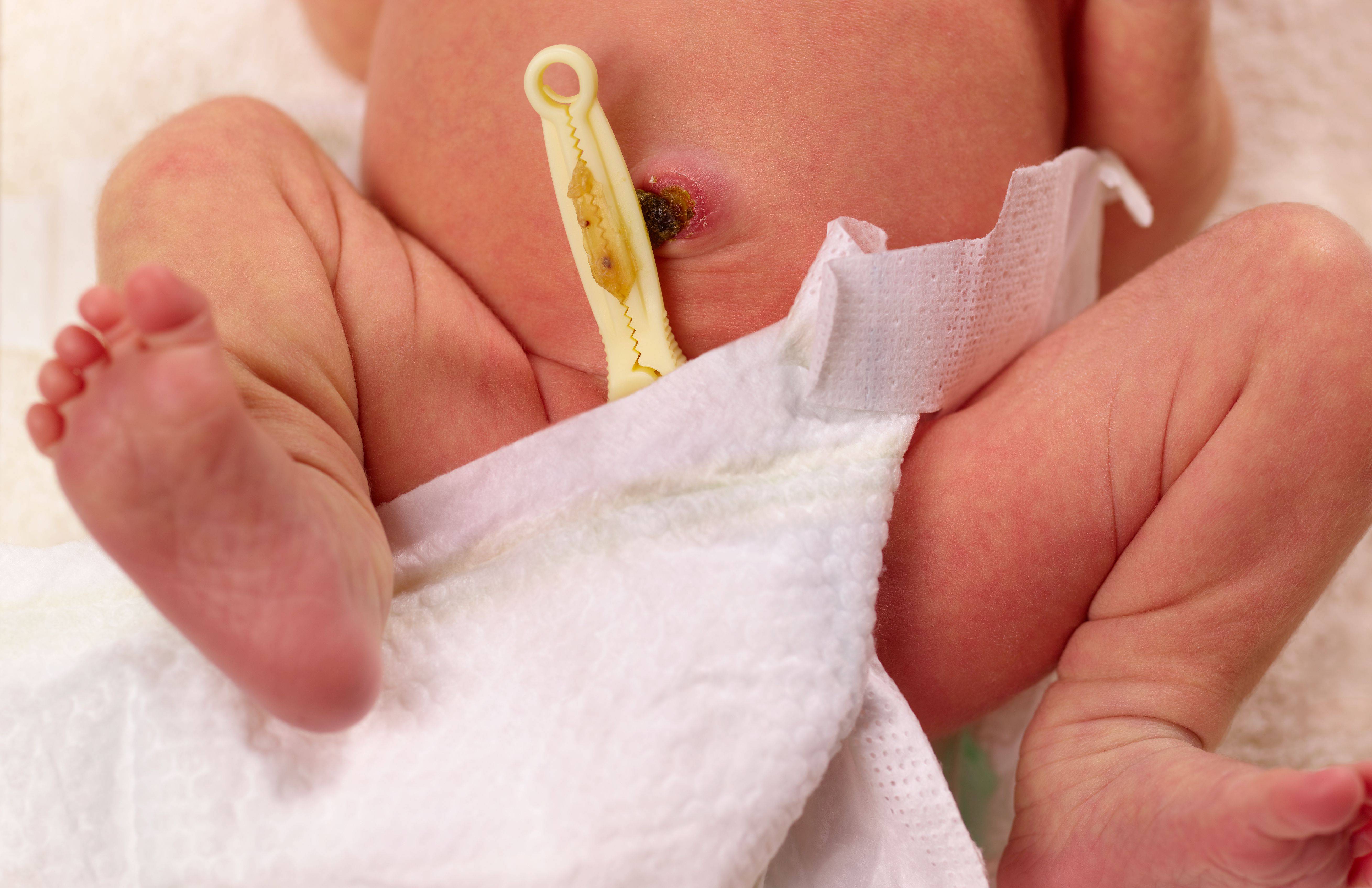 Обработка пупочной ранки у новорожденного ребенка в домашних условиях: алгоритм действий