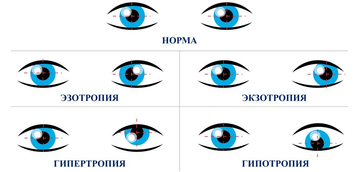 Косоглазие у новорожденных: на что обратить внимание? - клиника светланы богачевой