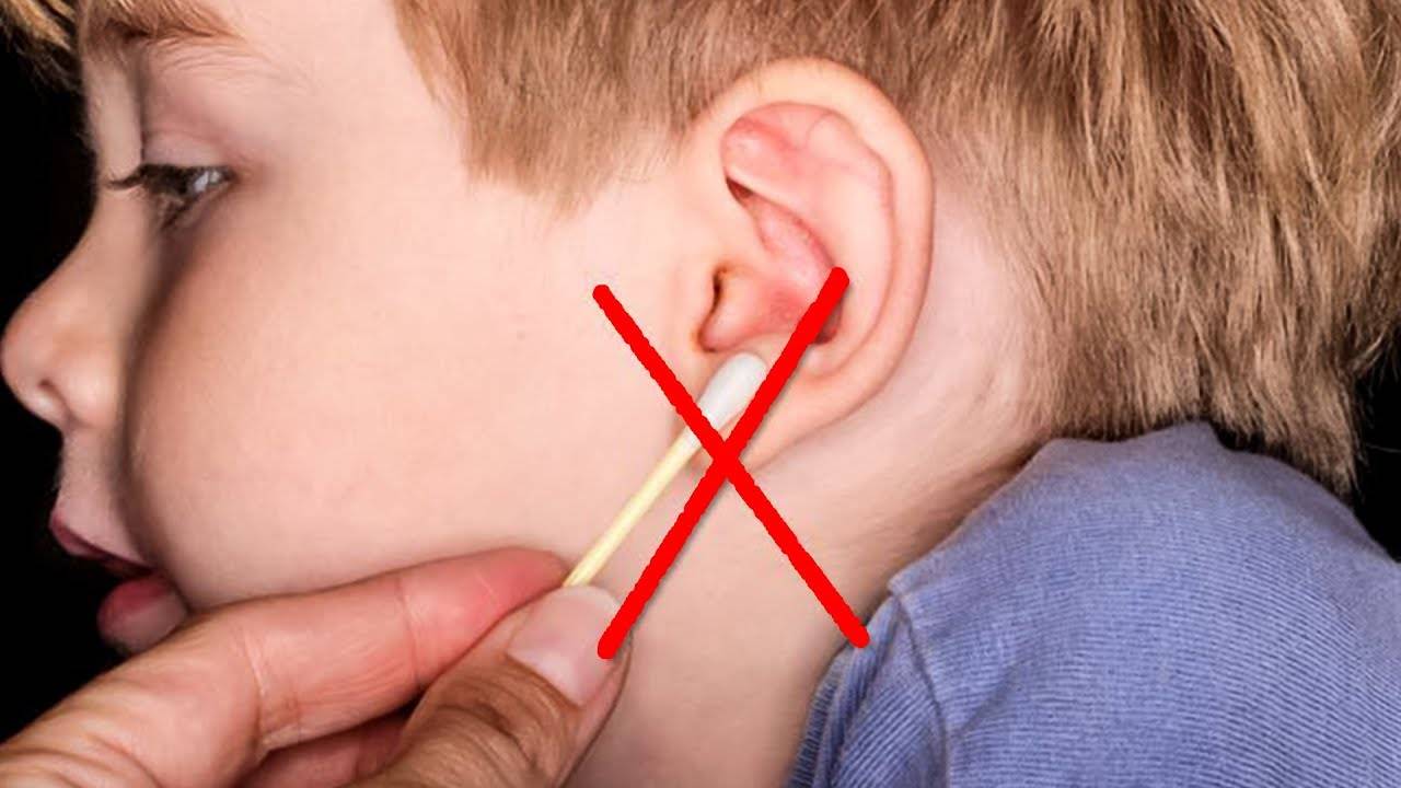 Серная пробка в ухе у ребенка — причины появления, симптомы, способы профилактики