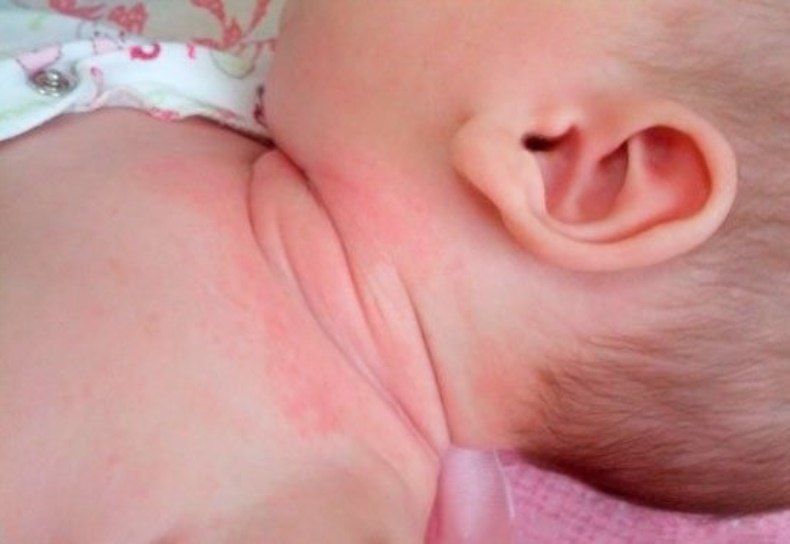 Опрелости у новорожденных детей: причины, лечение и профилатика опрелостей