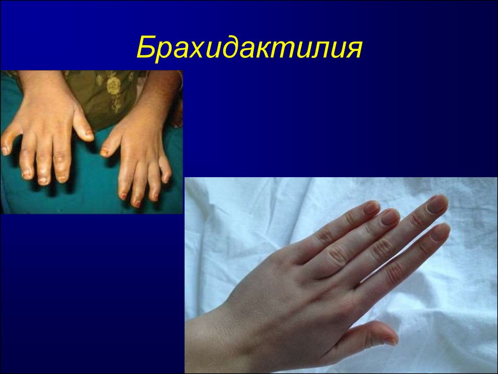 Брахидактилия большого пальца - что это такое, причины развития