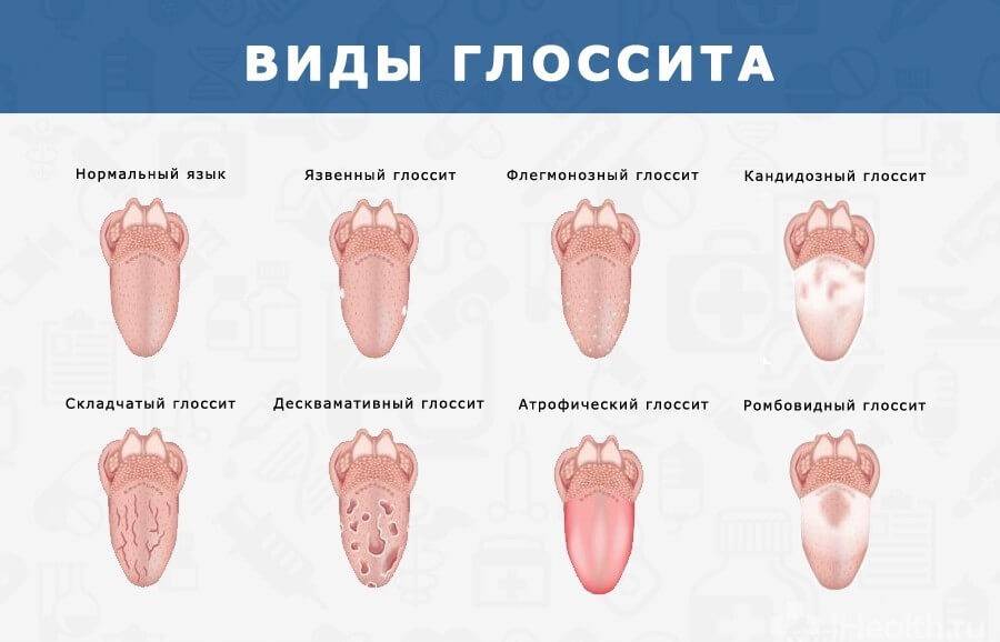 Диагностика заболеваний по языку: грибковые и бактериальные инфекции, обезвоживание, диабет и др. патологии | университетская клиника