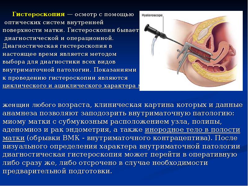 Гистероскопия