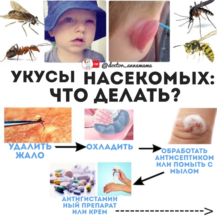 Aллергия на укусы комаров