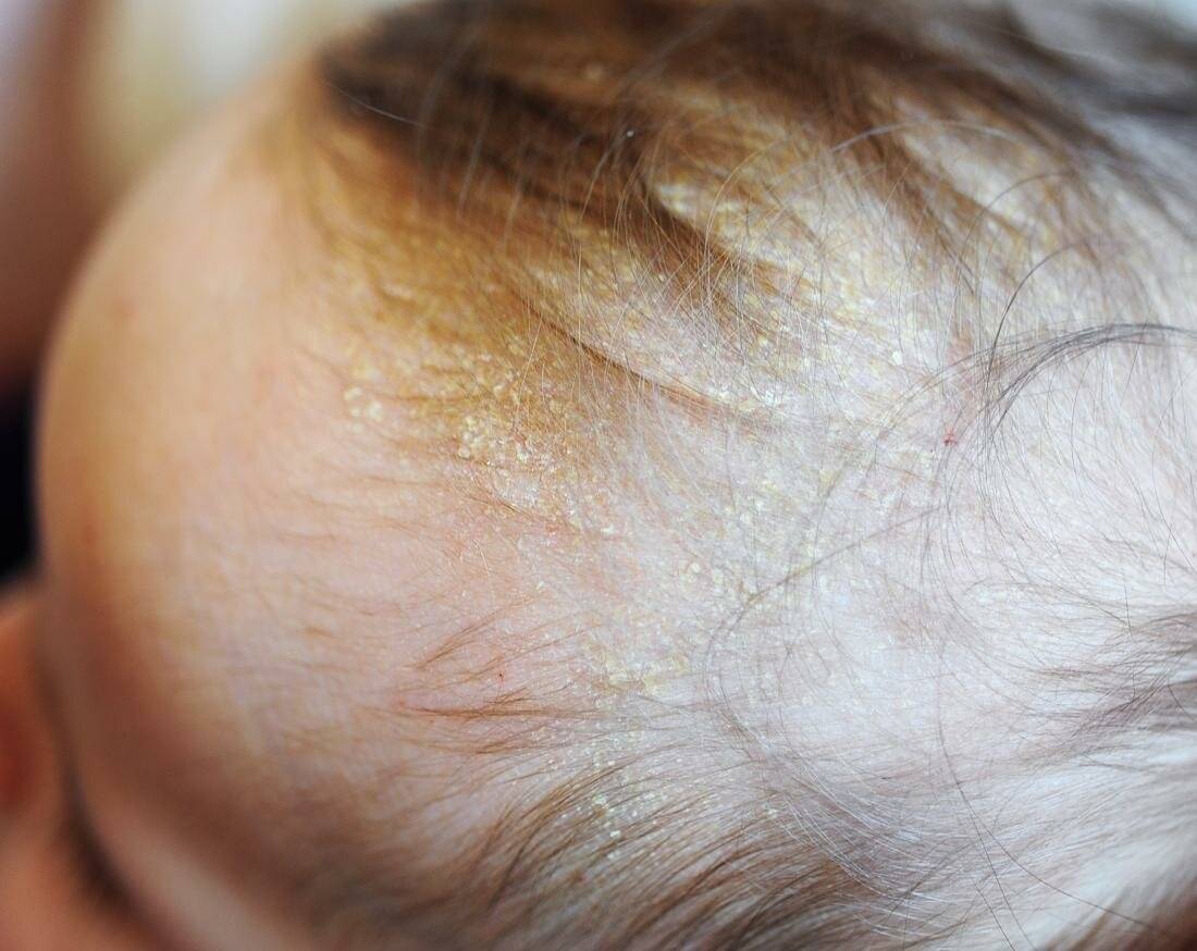 У новорожденного шелушится кожа на теле – что делать и как помочь малышу