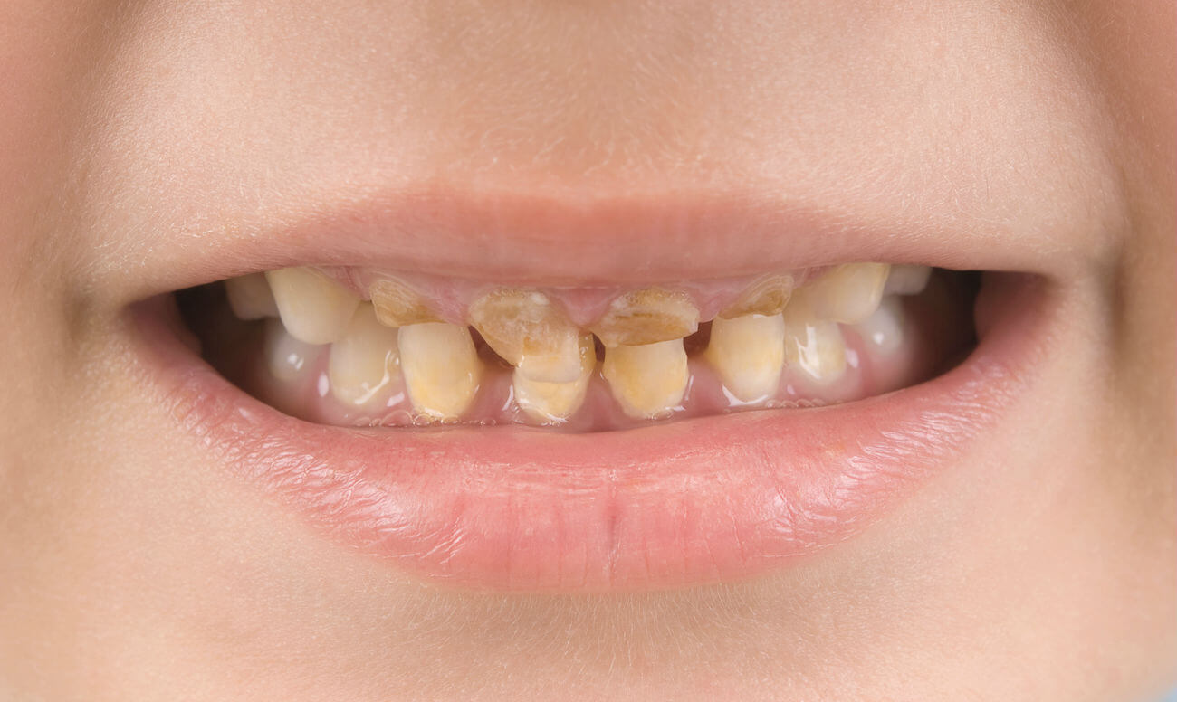 Кариес молочных зубов - причины появления, методы лечения