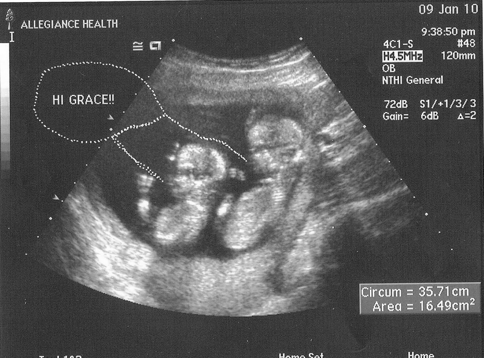 Аборт на 13 неделе беременности