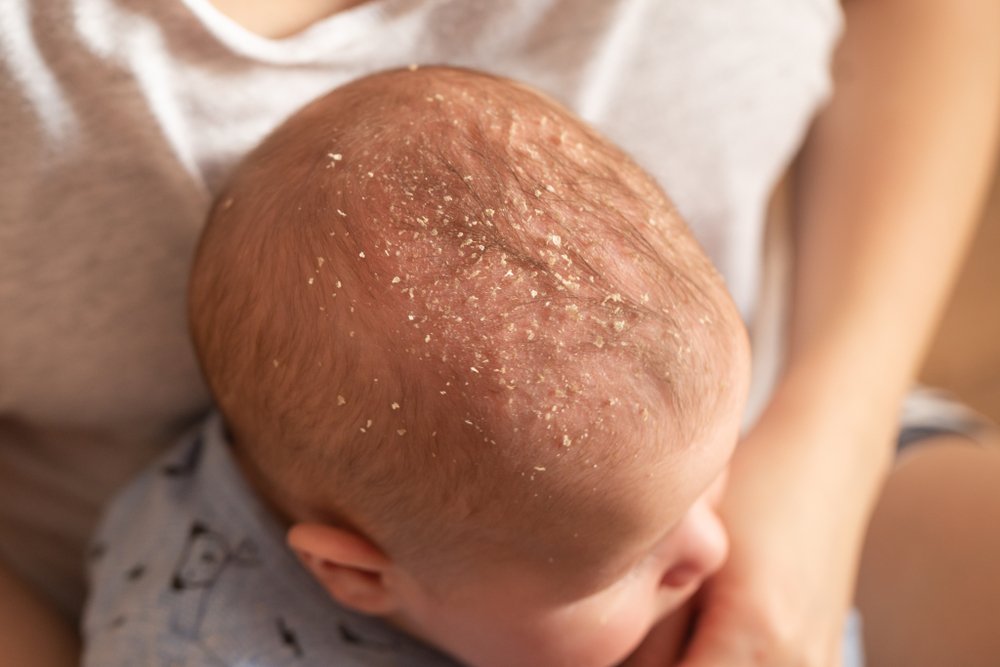 У новорожденного шелушится кожа на теле – что делать и как помочь малышу