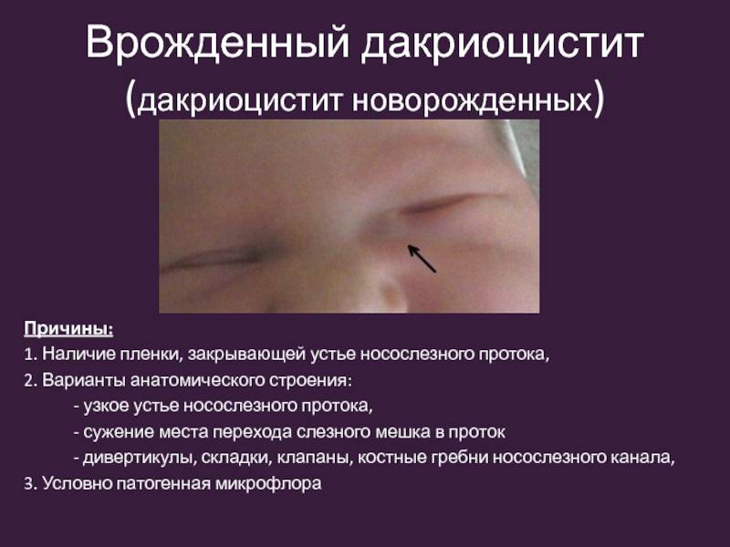 Симптомы и лечение дакриоцистита у новорожденных