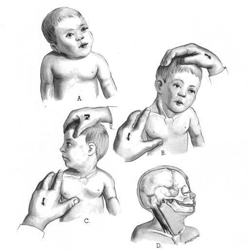Остеопатическое лечение кривошеи у новорожденных детей - детский остеопат в спб