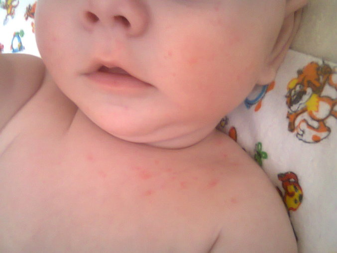 Сыпь на теле ребенка: особенности, виды, причины