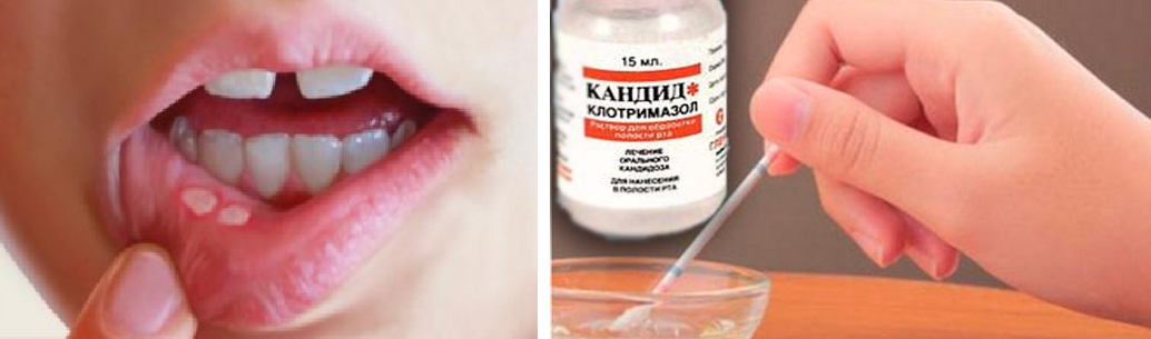 Что такое стоматит и как его предотвратить