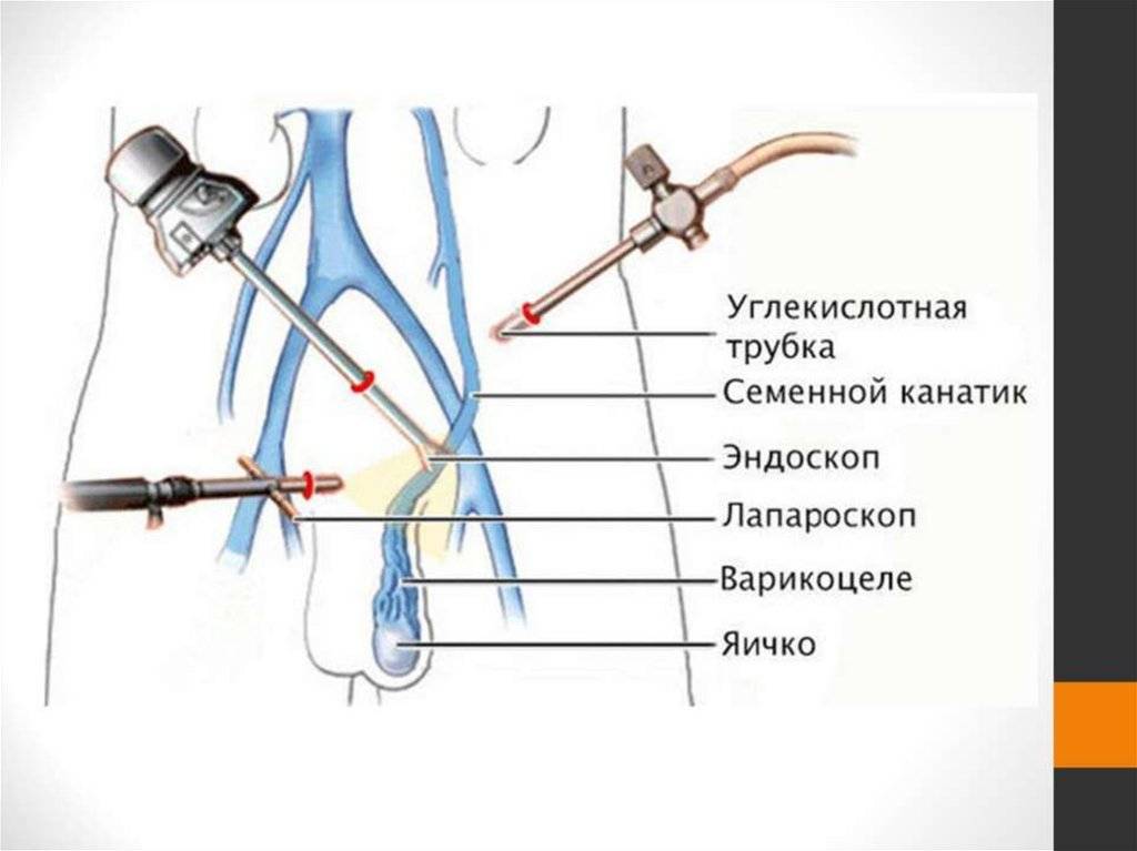 Операция мармара – микрохирургический метод операции варикоцеле у мужчин.