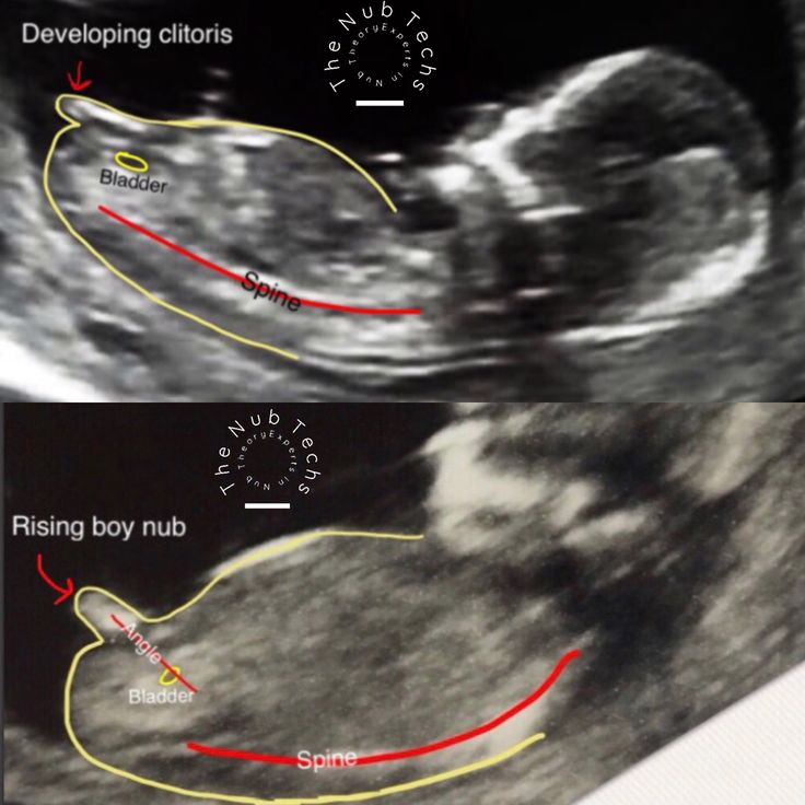 Девочки и мальчики на узи при беременности: как выглядит различие по полу?