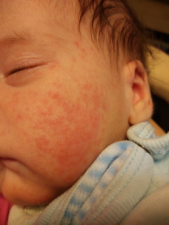 Цветение новорожденных: фото, признаки, лечение, комаровский