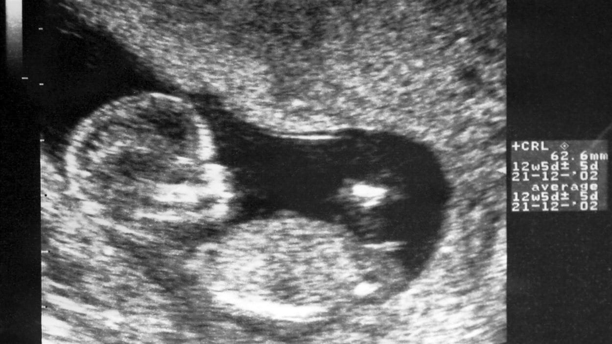 Можно ли определить пол ребенка по узи при беременности в 12 недель