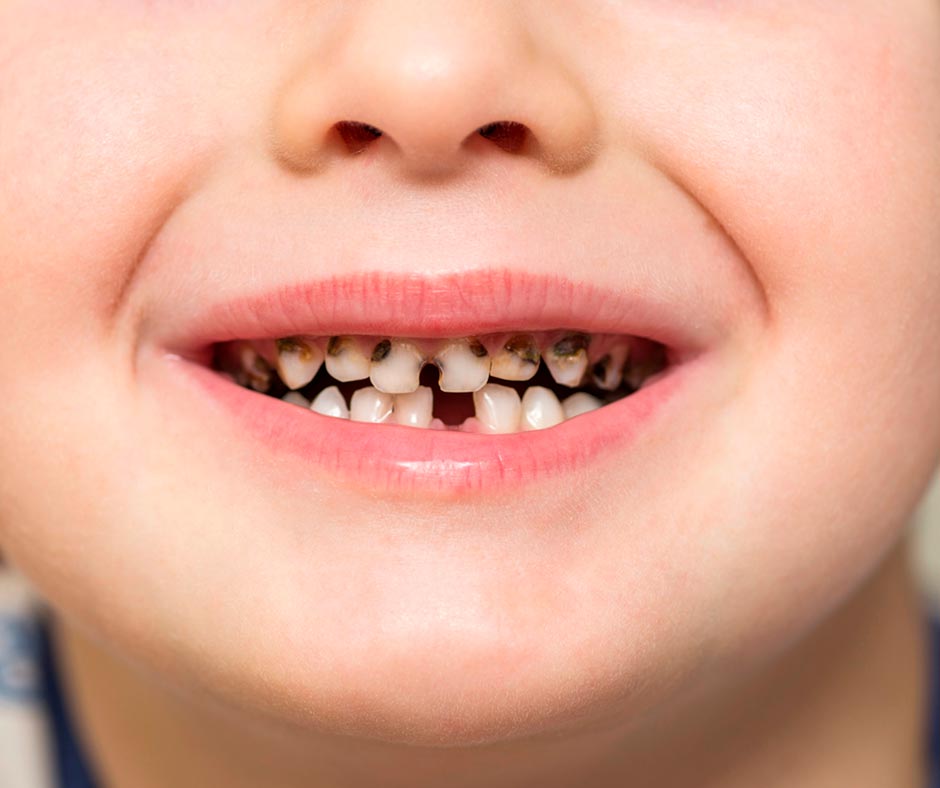 Видео: кариес молочных зубов – почему это опасно для вашего ребенка