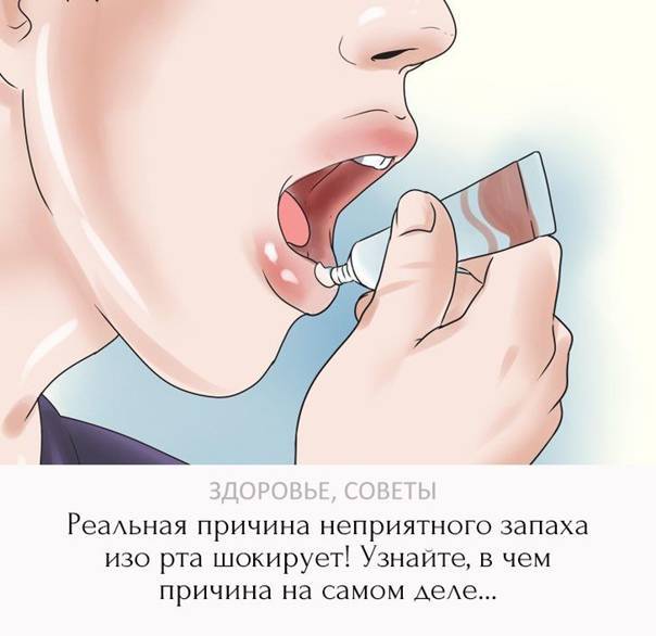 Неприятный запах изо рта у детей