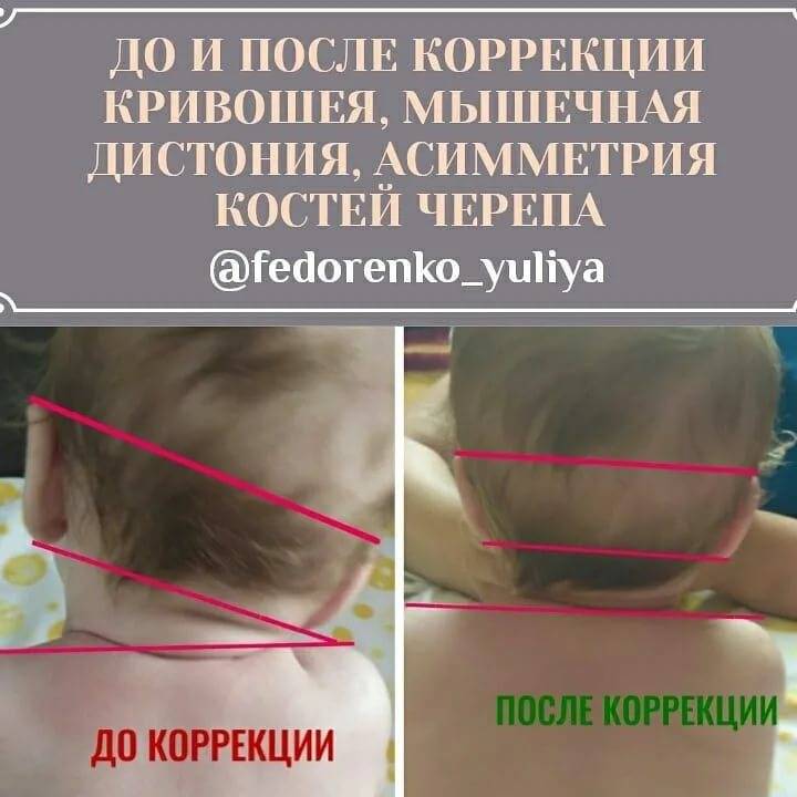 Кривошея и косоглазие у детей - энциклопедия ochkov.net