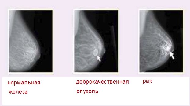 Что такое лактостаз? почему в молочных железах происходит застой?